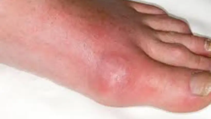 best essential oils for gout